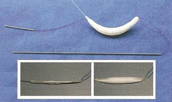 Jak wygląda implant stosowany do powiększania ust