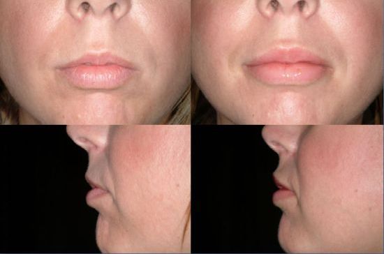 Powiększanie ust implantami silikonowymi - efekt przed i po.